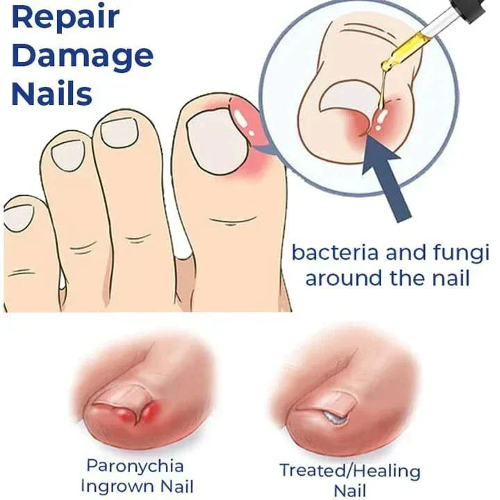 Anti Paronychia Relief Oil - Buy 1 Get 1 FREE🔥