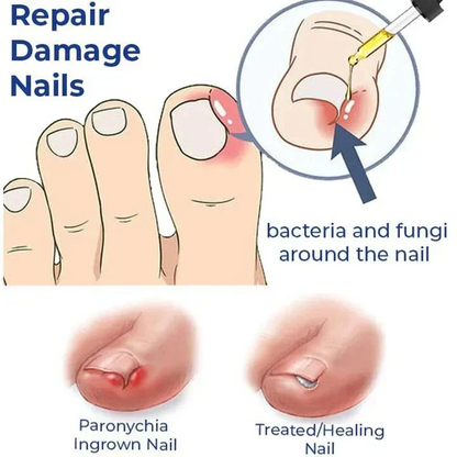 Anti Paronychia Relief Oil - Buy 1 Get 1 FREE🔥