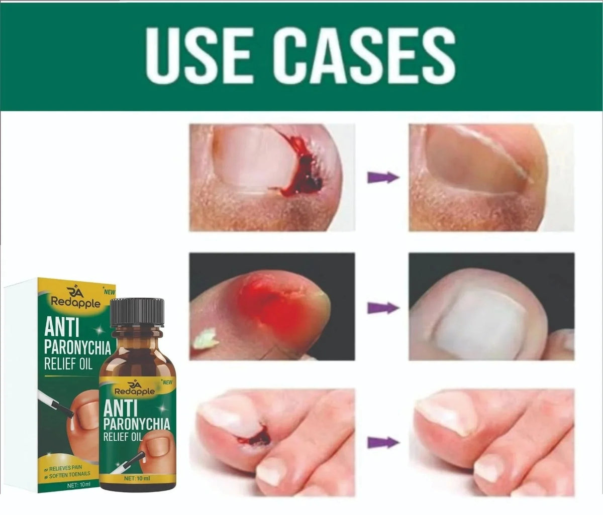 Anti Paronychia Relief Oil - Buy 1 Get 1 FREE🔥