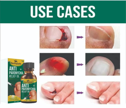 Anti Paronychia Relief Oil - Buy 1 Get 1 FREE🔥